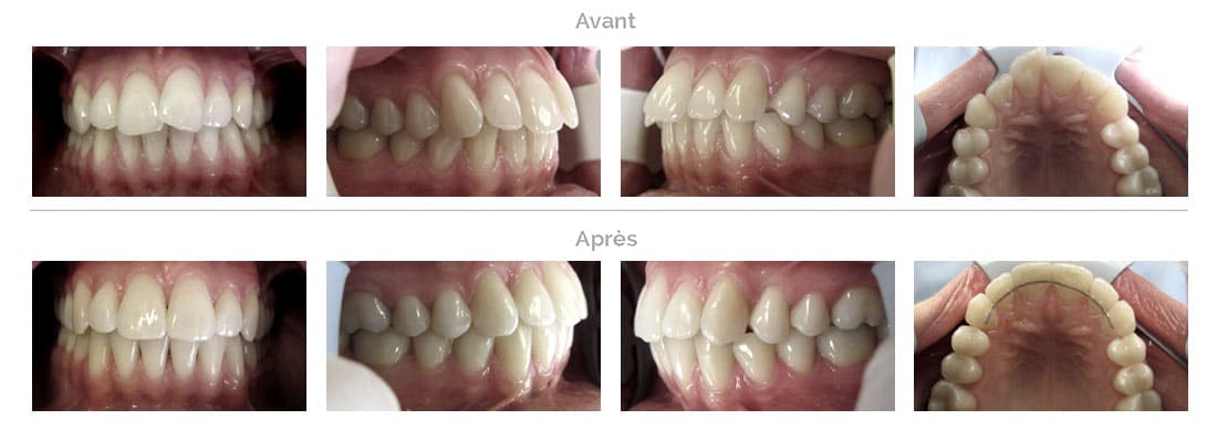 Traitement Invisalign : chevauchement léger