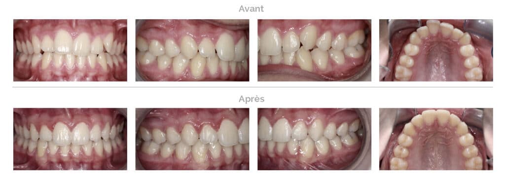 Invisalign treatment: rotated teeth