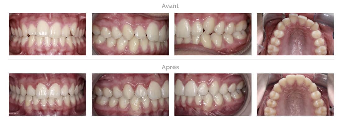 Traitement Invisalign : dents tournées