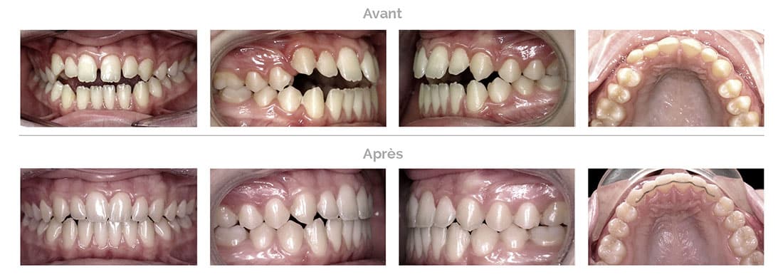 Traitement Invisalign : espaces interdentaires