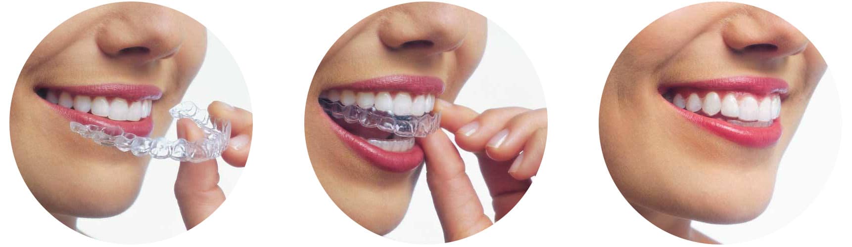 orthodontie-invisible-gouttière-aligner Orthodontic treatment in Brussels - open bite