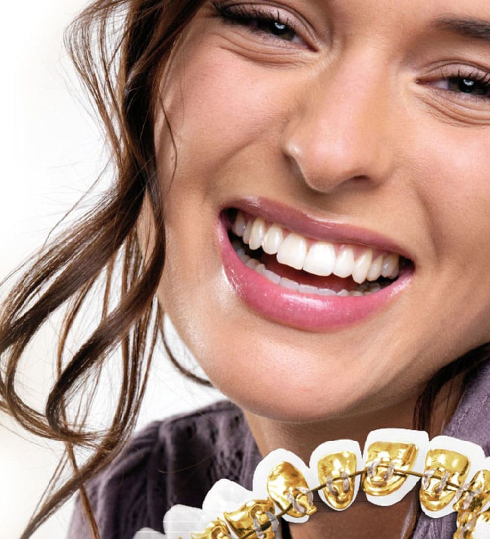 Orthodontie linguale à Bruxelles - iDent Clinic