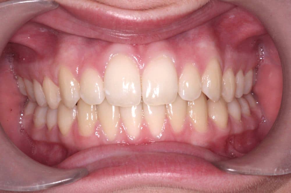 traitement-orthodontie-bruxelles-beance-apres Orthodontic treatment in Brussels - open bite treated