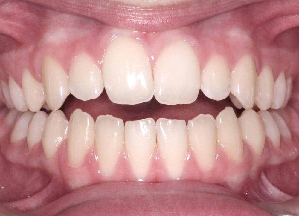 traitement-orthodontie-bruxelles-beance-avant Orthodontic treatment in Brussels - open bite