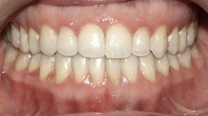 traitement-orthodontie-bruxelles-bout-a-bout-apres Orthodontic treatment in Brussels - edge-to-edge bite traité