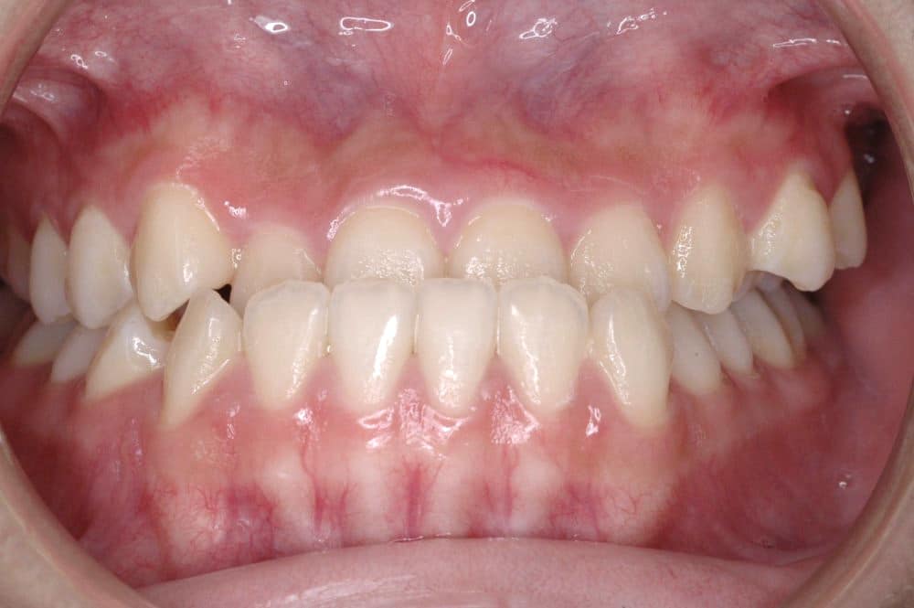 traitement-orthodontie-bruxelles-crossbite-avant Orthodontic treatment in Brussels - crossbite