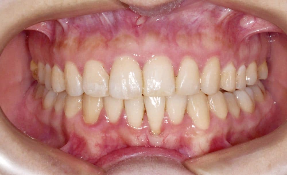 traitement-orthodontie-bruxelles-grand-chevauchement-apres Orthodontic treatment in Brussels - severe crowding traité