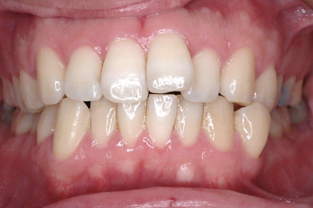 traitement-orthodontie-bruxelles-incisive-avant Orthodontic treatment in Brussels - incisor