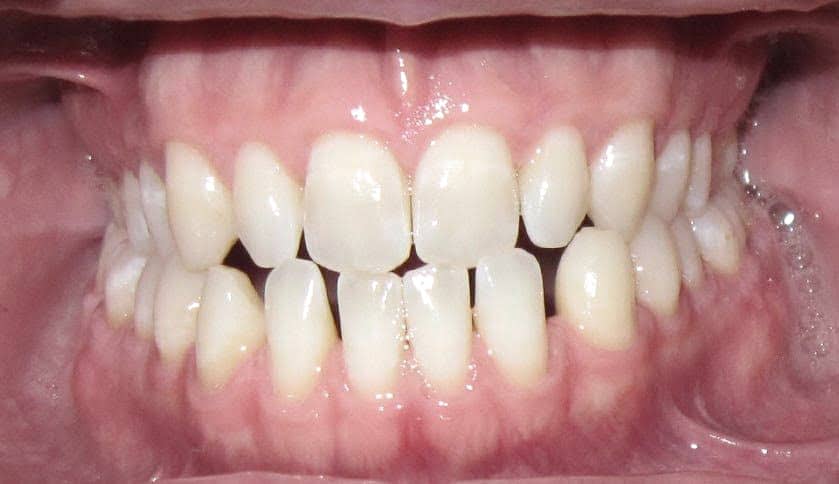 traitement-orthodontie-bruxelles-espaces-avant Orthodontic treatment in Brussels - I have gaps between my teeth