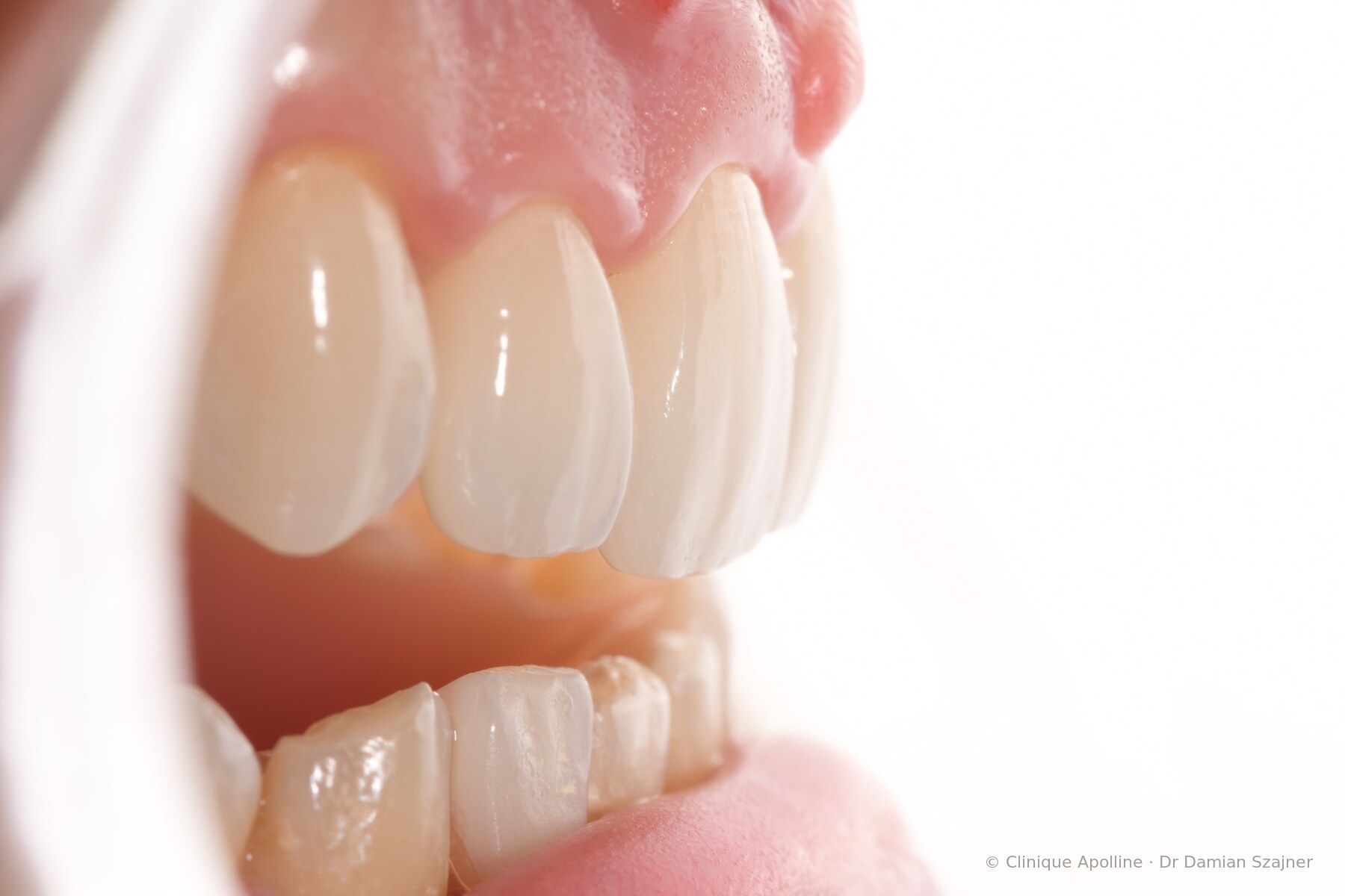 Vue de profil d’un résultat esthétique en céramique sur les dents antérieures