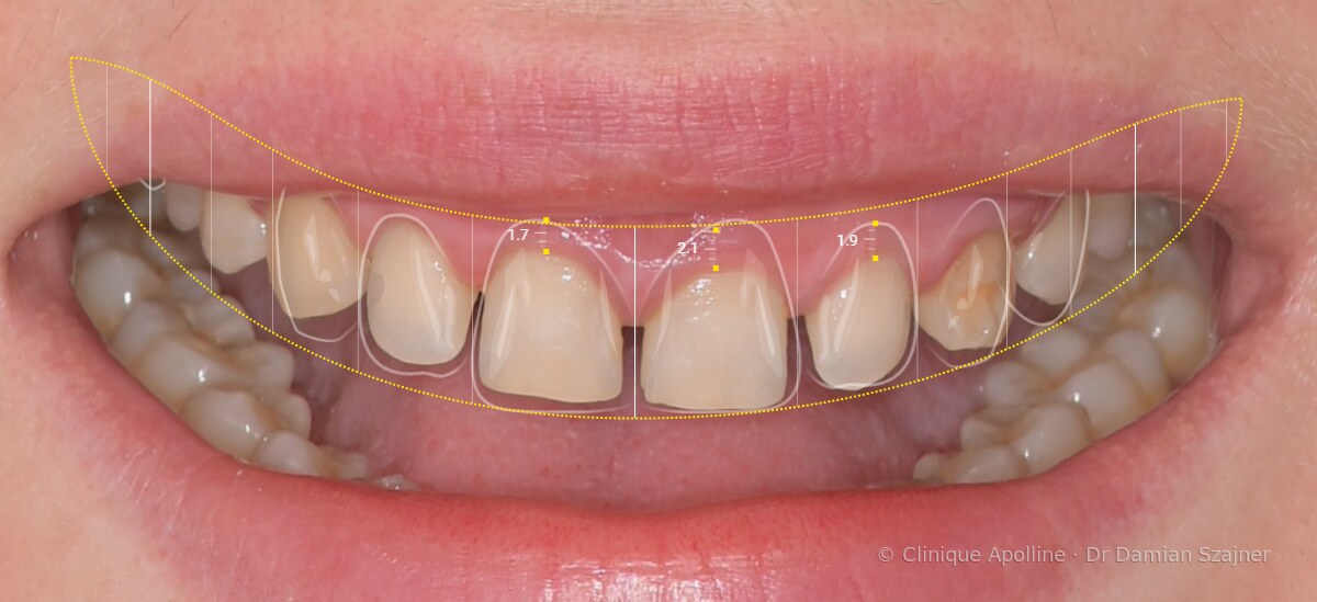 Planification numérique des proportions des dents supérieures et de la ligne du sourire